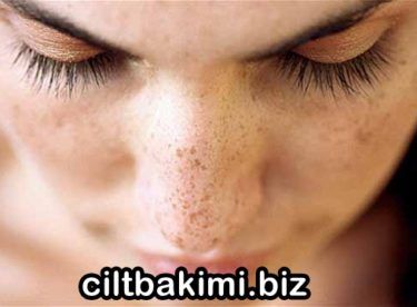 Cilt Lekeleri için Maske