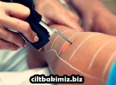 Lazer Epilasyon Nasıl Yapılır, Lazer Epilasyon Hangi Bölgelere Uygulanır