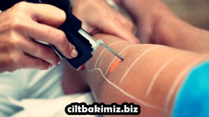 Lazer Epilasyon Nasıl Yapılır, Lazer Epilasyon Hangi Bölgelere Uygulanır