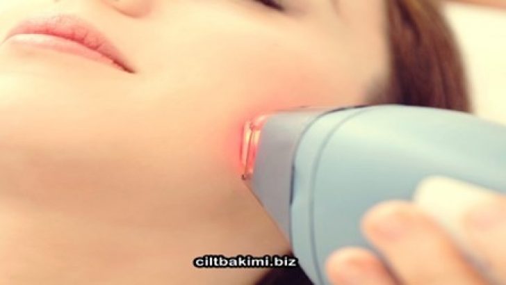 Yüz Epilasyonu