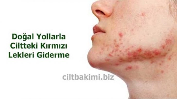 Yüzdeki Kırmızı Lekeler Nasıl Geçer